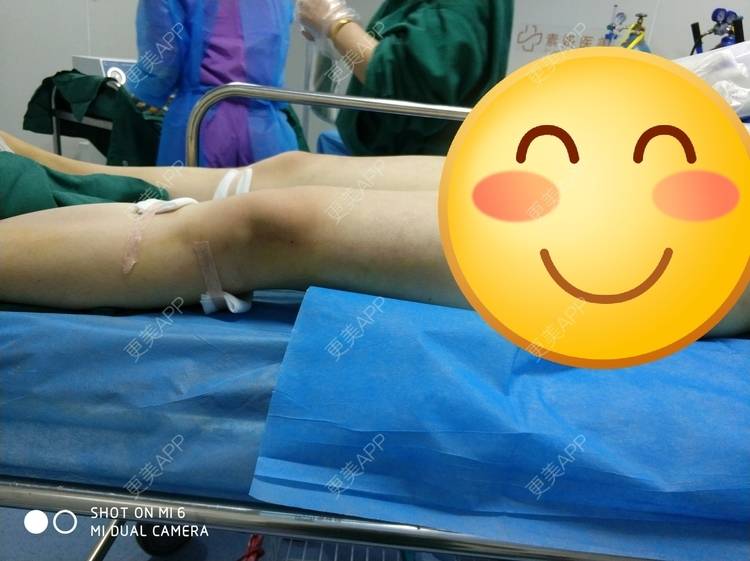 更美 - 更美用户yE8KtSeMLF的小腿吸脂经验 | 小腿吸脂 | 长沙