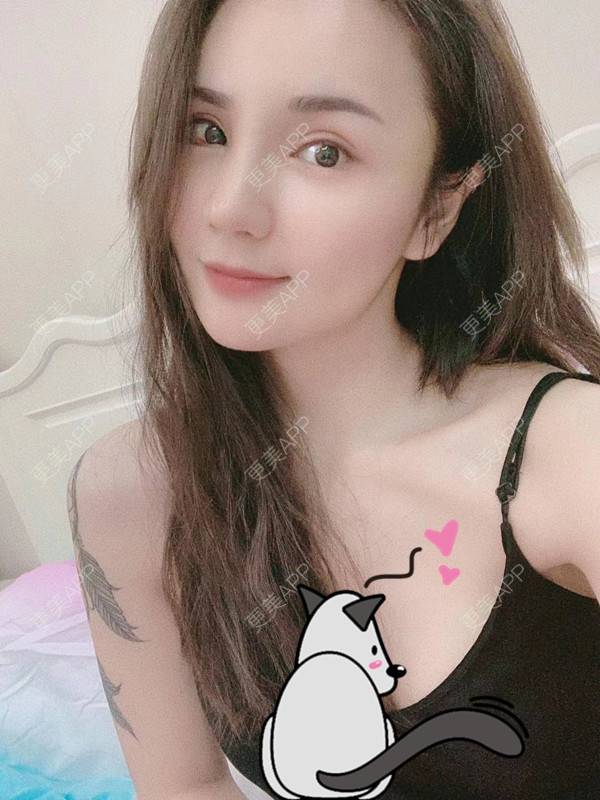 更美 - 更美用户3dxq4evfQ4的手臂吸脂经验 | 手臂吸脂