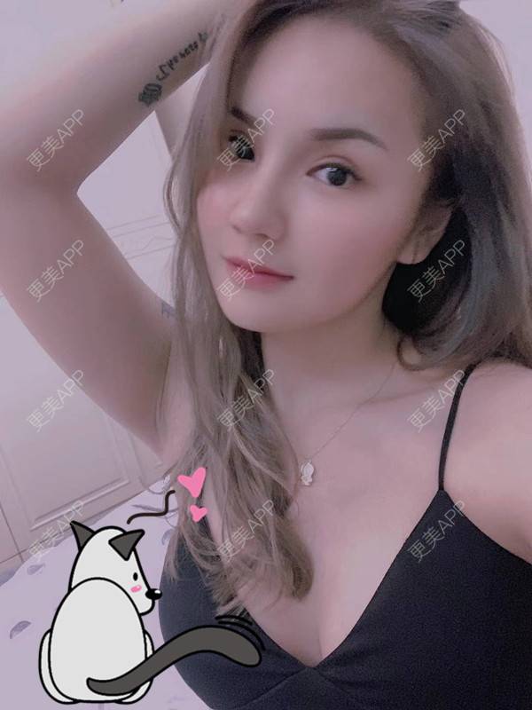 更美 - 更美用户3dxq4evfQ4的手臂吸脂经验 | 手臂吸脂