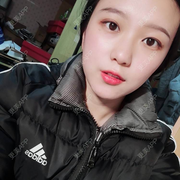 更美 - Baby熊熊的颧骨内推经验 | 颧骨颧弓整形 | 颧骨内推