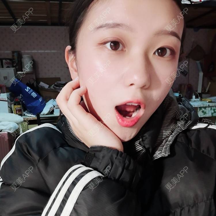 更美 - Baby熊熊的颧骨内推经验 | 颧骨颧弓整形 | 颧骨内推
