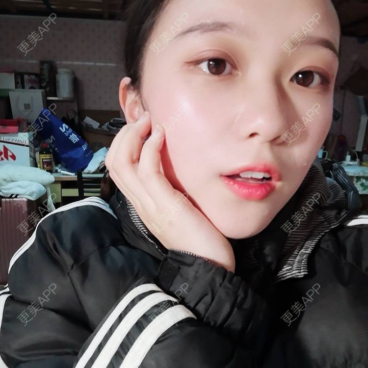 更美 - Baby熊熊的颧骨内推经验 | 颧骨颧弓整形 | 颧骨内推