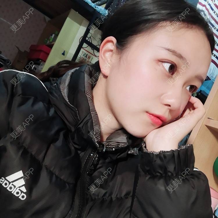 更美 - Baby熊熊的颧骨内推经验 | 颧骨颧弓整形 | 颧骨内推