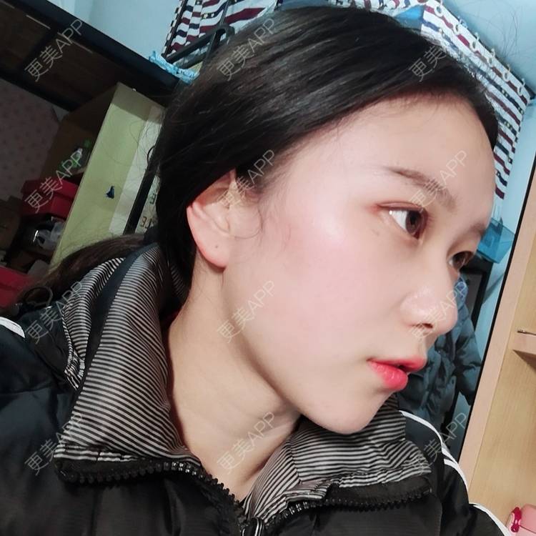更美 - Baby熊熊的颧骨内推经验 | 颧骨颧弓整形 | 颧骨内推