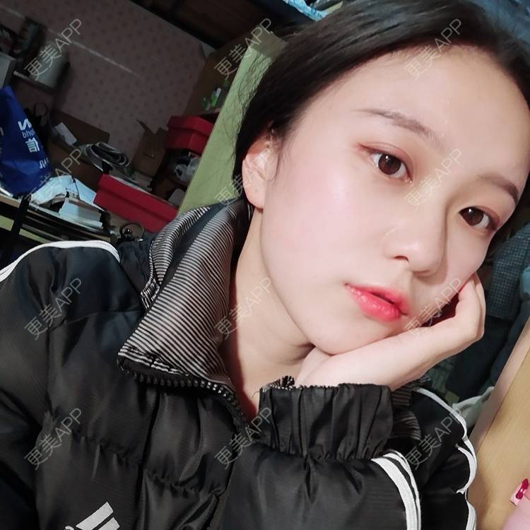 更美 - Baby熊熊的颧骨内推经验 | 颧骨颧弓整形 | 颧骨内推