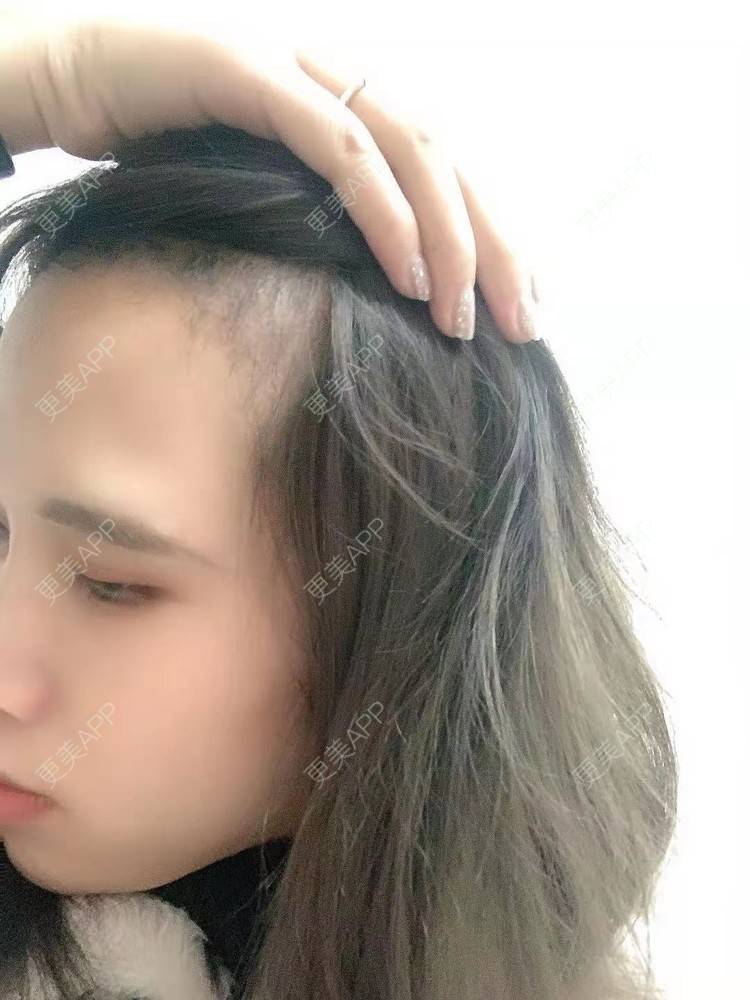 更美 - 更美用户AsYuVHaNVn的植发际线经验 | 广州 | 视频日记 | 植发际线