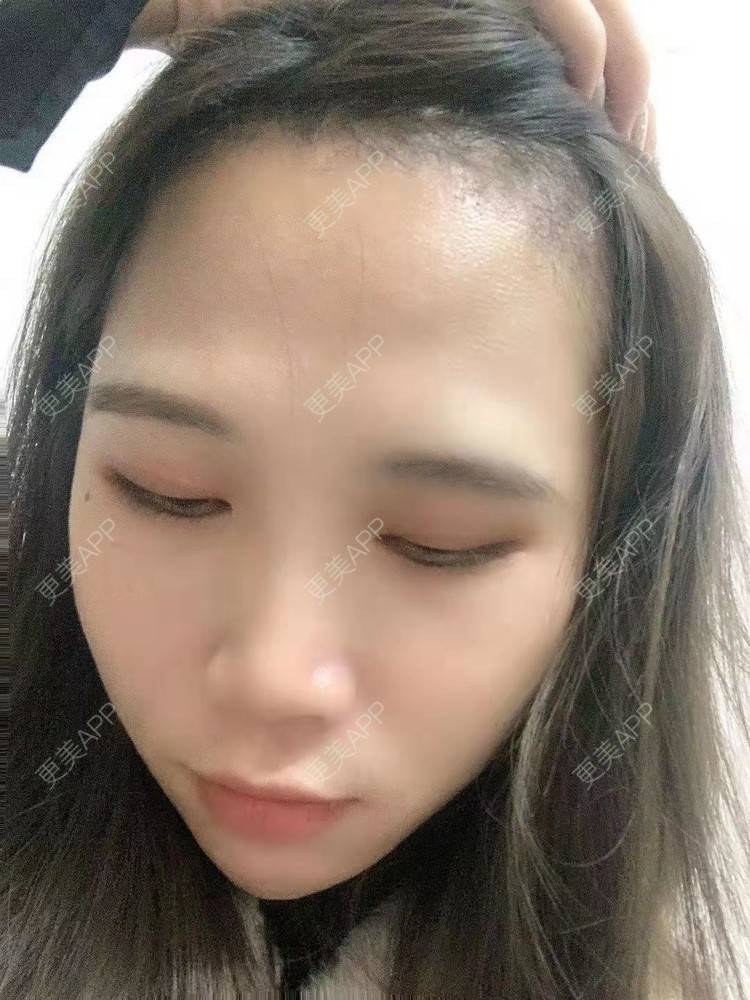 更美 - 更美用户AsYuVHaNVn的植发际线经验 | 广州 | 视频日记 | 植发际线