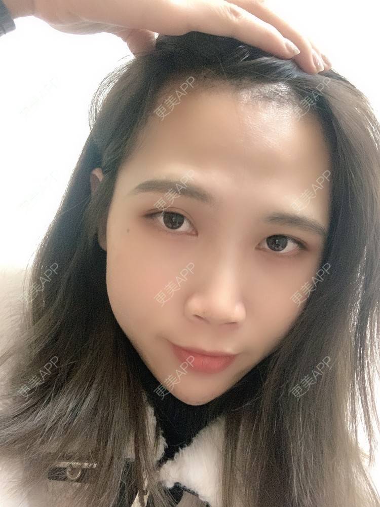 更美 - 更美用户AsYuVHaNVn的植发际线经验 | 广州 | 视频日记 | 植发际线