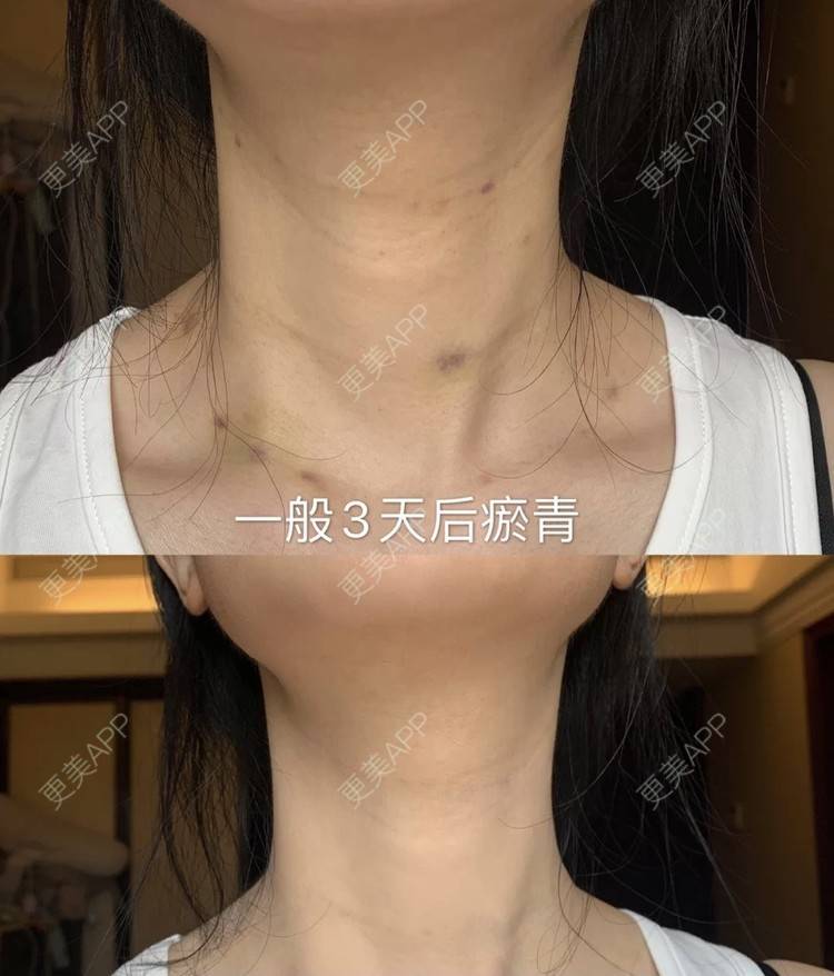 更美 - 更美用户gQVC0NnfJE的嗨体淡化颈纹经验 | 嗨体淡化颈纹 | 南京