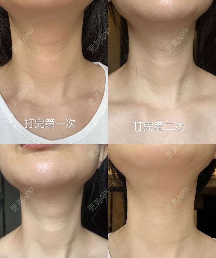 更美 - 更美用户gQVC0NnfJE的嗨体淡化颈纹经验 | 嗨体淡化颈纹 | 南京
