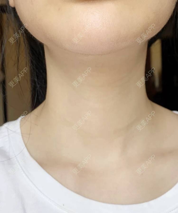 更美 - 更美用户gQVC0NnfJE的嗨体淡化颈纹经验 | 嗨体淡化颈纹 | 南京