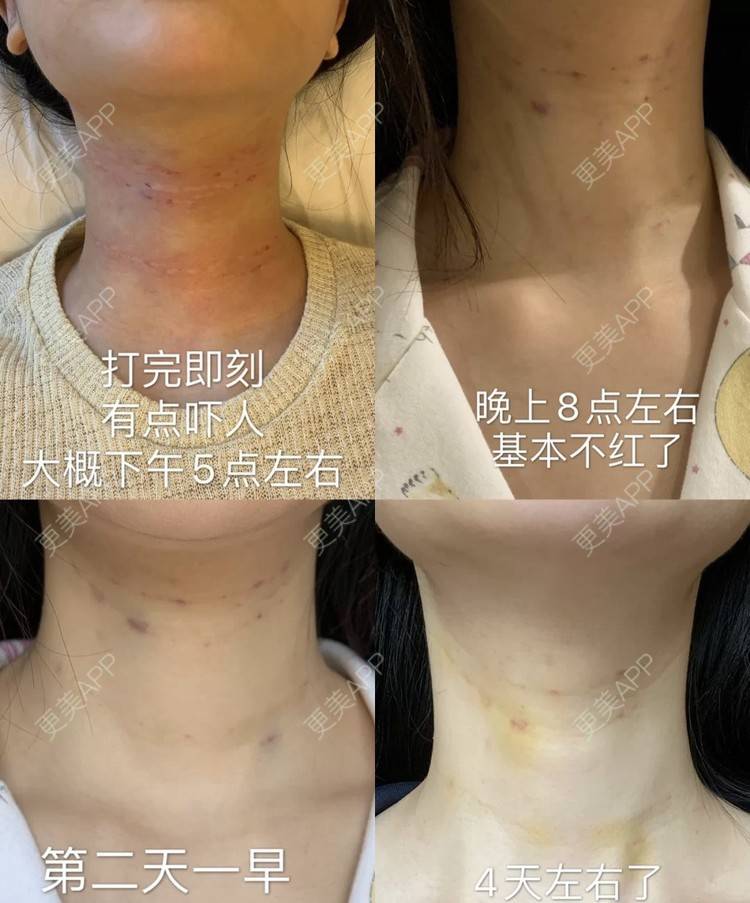 更美 - 更美用户gQVC0NnfJE的嗨体淡化颈纹经验 | 嗨体淡化颈纹 | 南京