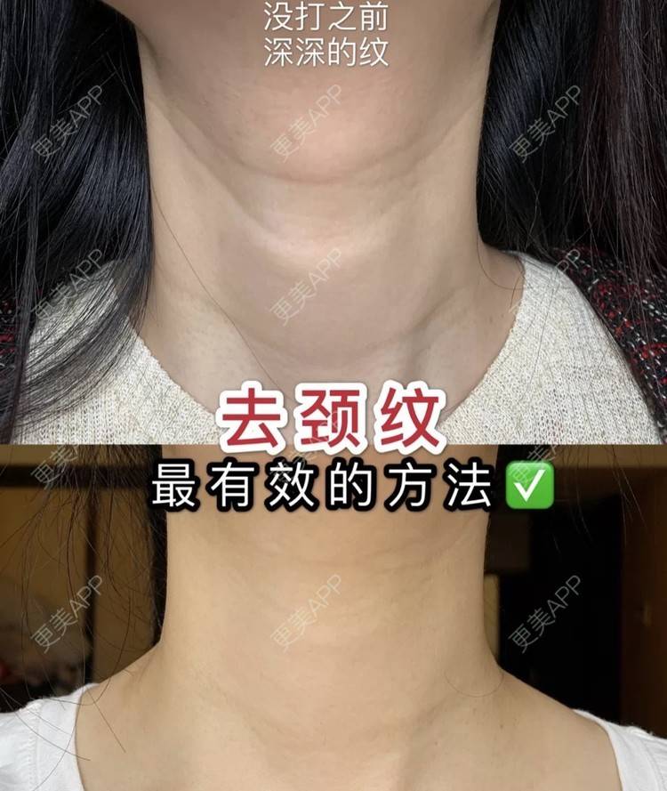 更美 - 更美用户gQVC0NnfJE的嗨体淡化颈纹经验 | 嗨体淡化颈纹 | 南京