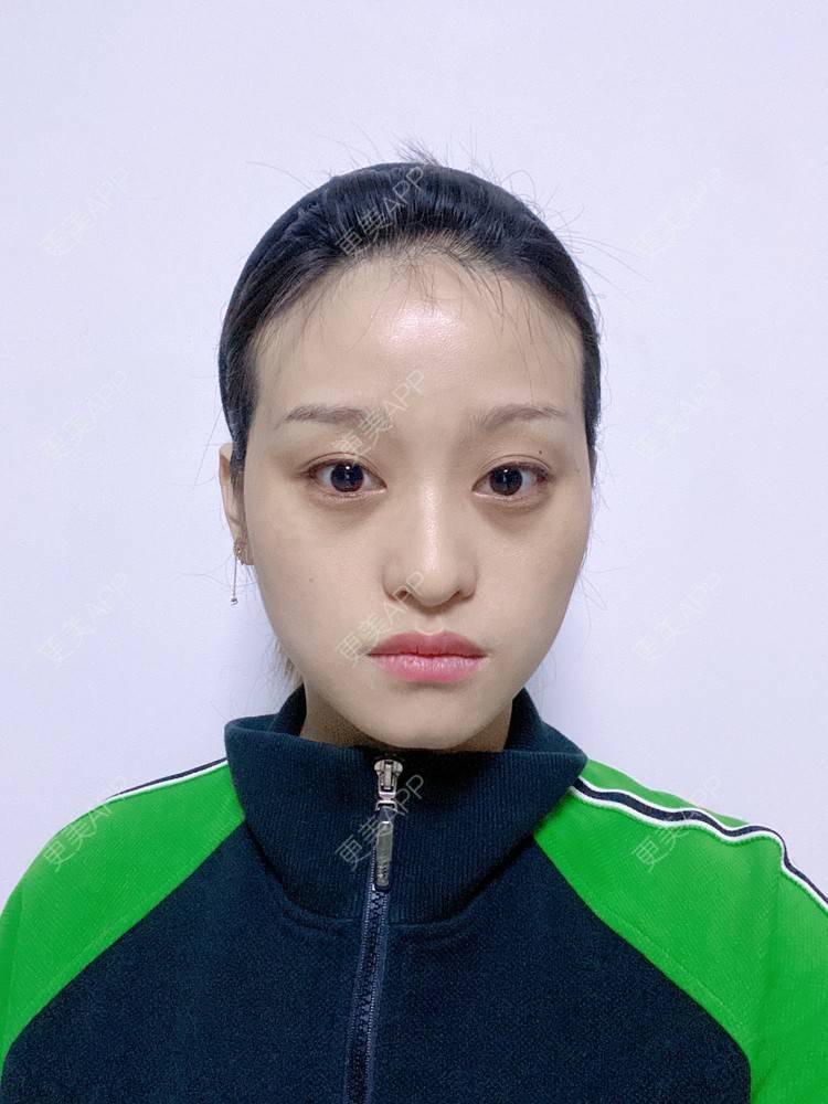更美 - 本宫就是矫情、哼哼的瘦脸经验 | 注射溶脂瘦脸 | 瘦脸