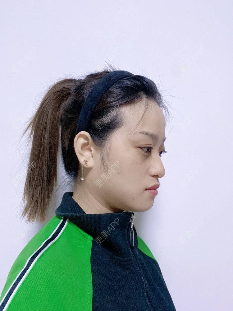 更美 - 本宫就是矫情、哼哼的瘦脸经验 | 注射溶脂瘦脸 | 瘦脸