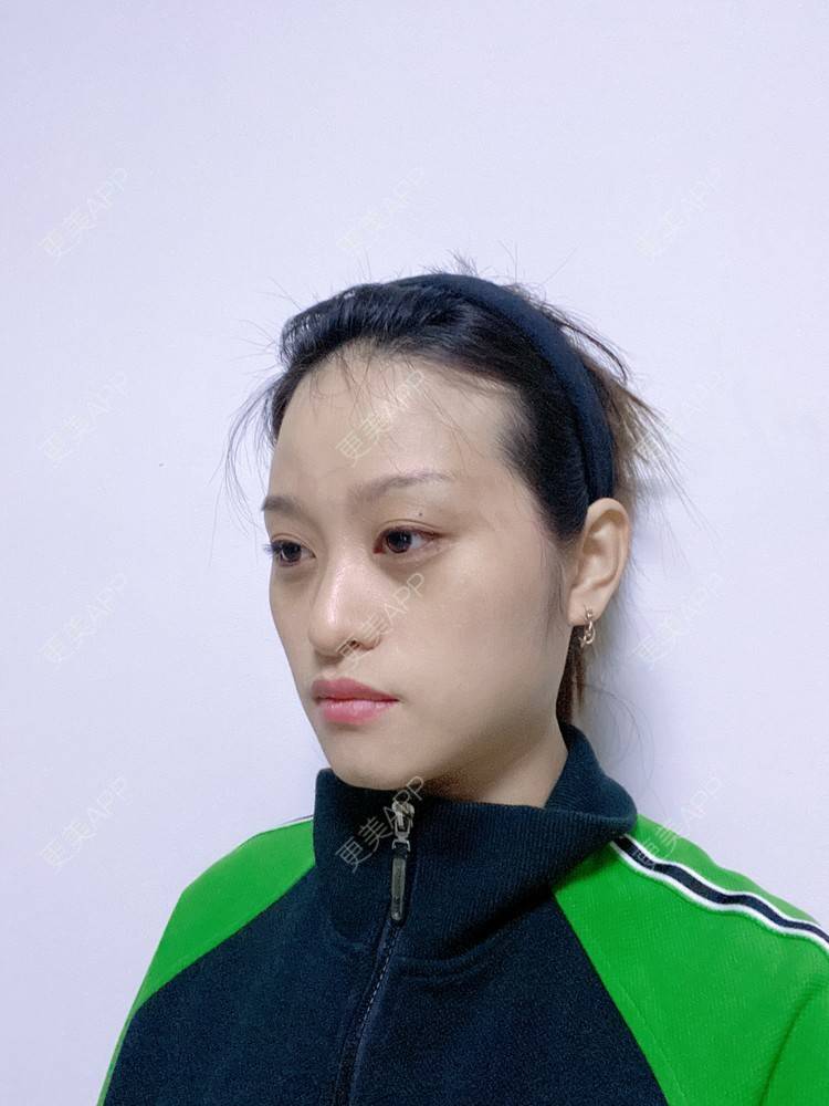 更美 - 本宫就是矫情、哼哼的瘦脸经验 | 注射溶脂瘦脸 | 瘦脸