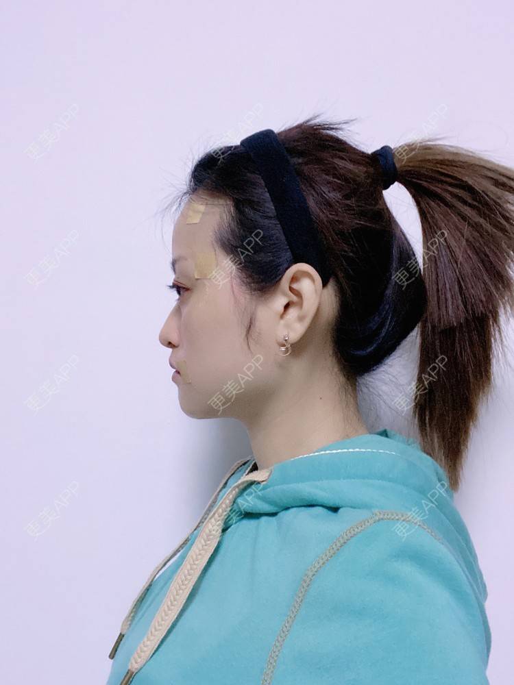 更美 - 本宫就是矫情、哼哼的瘦脸经验 | 注射溶脂瘦脸 | 瘦脸