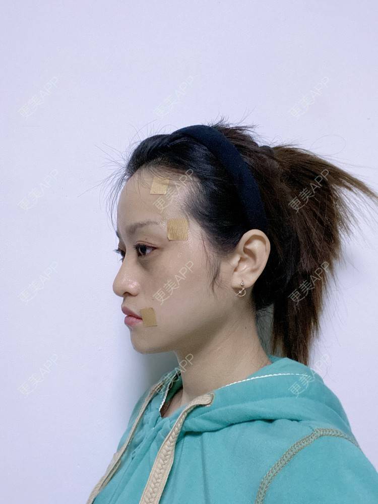 更美 - 本宫就是矫情、哼哼的瘦脸经验 | 注射溶脂瘦脸 | 瘦脸