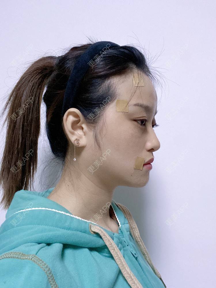 更美 - 本宫就是矫情、哼哼的瘦脸经验 | 注射溶脂瘦脸 | 瘦脸