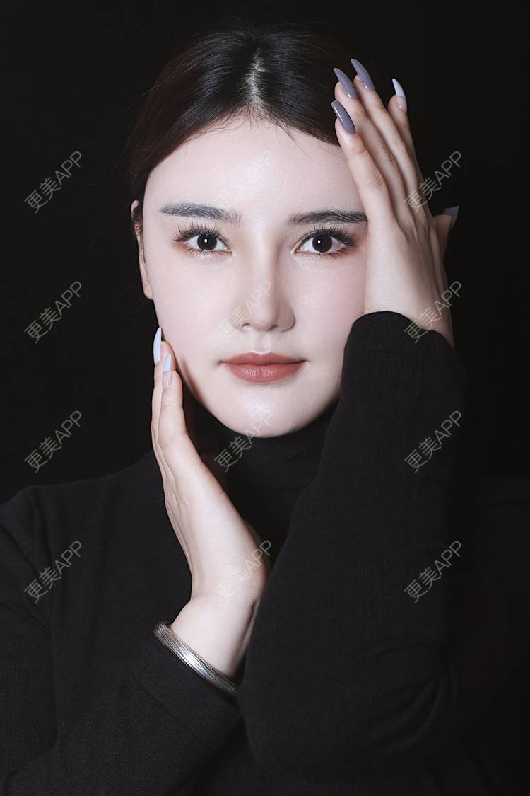 更美 - 湛蓝滴玫瑰的自体软骨垫鼻尖经验 | 自体软骨垫鼻尖 | 鼻翼缩小 | 重庆 | 鼻孔矫正 | 鼻形态修复