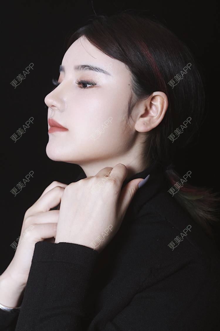 更美 - 湛蓝滴玫瑰的自体软骨垫鼻尖经验 | 自体软骨垫鼻尖 | 鼻翼缩小 | 重庆 | 鼻孔矫正 | 鼻形态修复