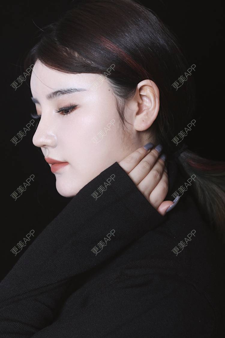 更美 - 湛蓝滴玫瑰的自体软骨垫鼻尖经验 | 自体软骨垫鼻尖 | 鼻翼缩小 | 重庆 | 鼻孔矫正 | 鼻形态修复