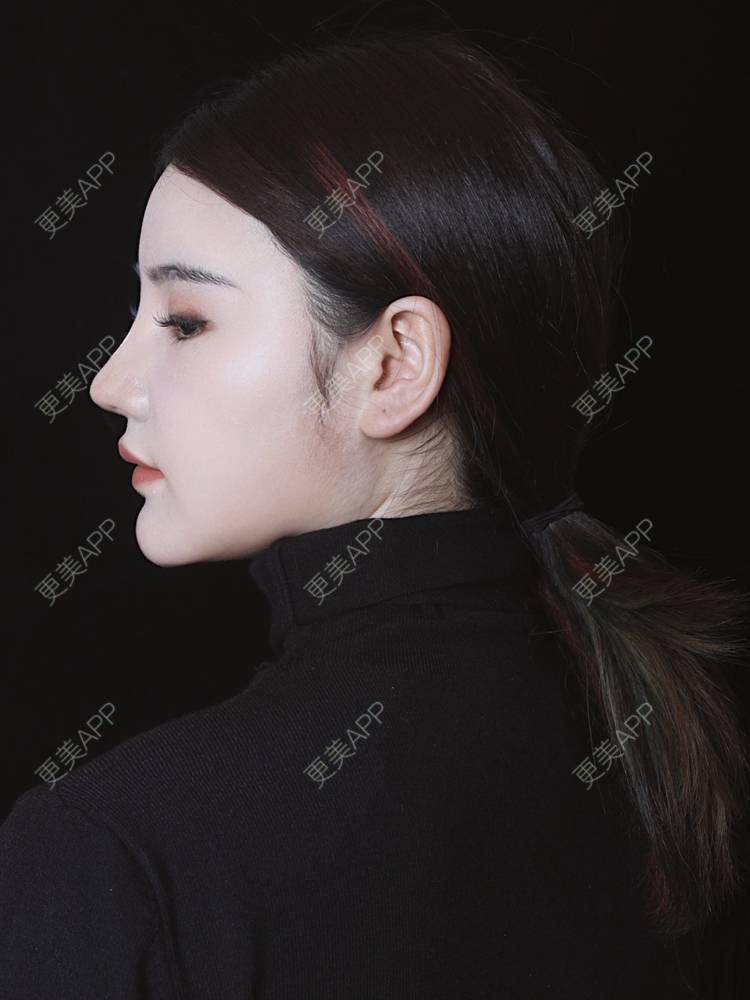 更美 - 湛蓝滴玫瑰的自体软骨垫鼻尖经验 | 自体软骨垫鼻尖 | 鼻翼缩小 | 重庆 | 鼻孔矫正 | 鼻形态修复