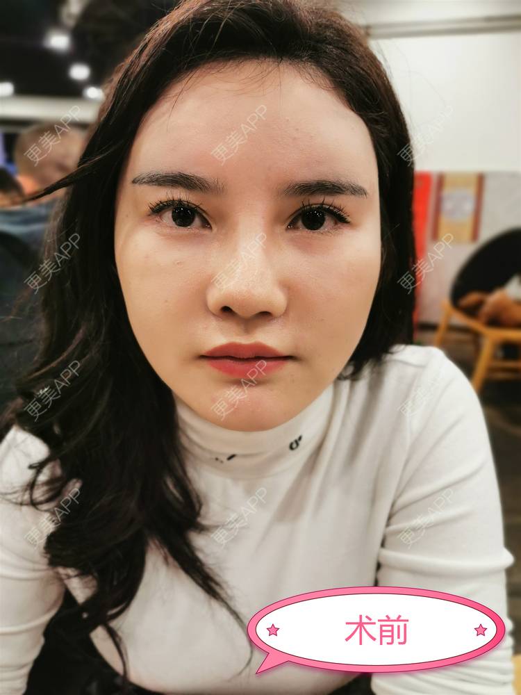 更美 - 湛蓝滴玫瑰的自体软骨垫鼻尖经验 | 自体软骨垫鼻尖 | 鼻翼缩小 | 重庆 | 鼻孔矫正 | 鼻形态修复