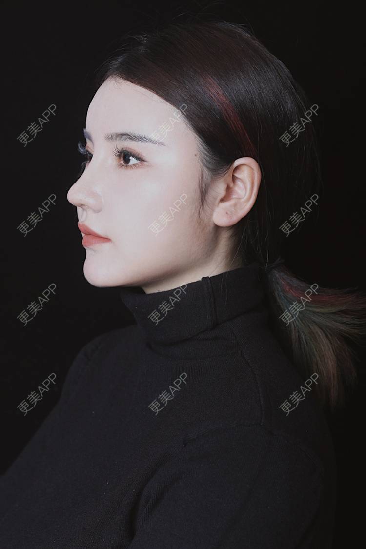 更美 - 湛蓝滴玫瑰的自体软骨垫鼻尖经验 | 自体软骨垫鼻尖 | 鼻翼缩小 | 重庆 | 鼻孔矫正 | 鼻形态修复