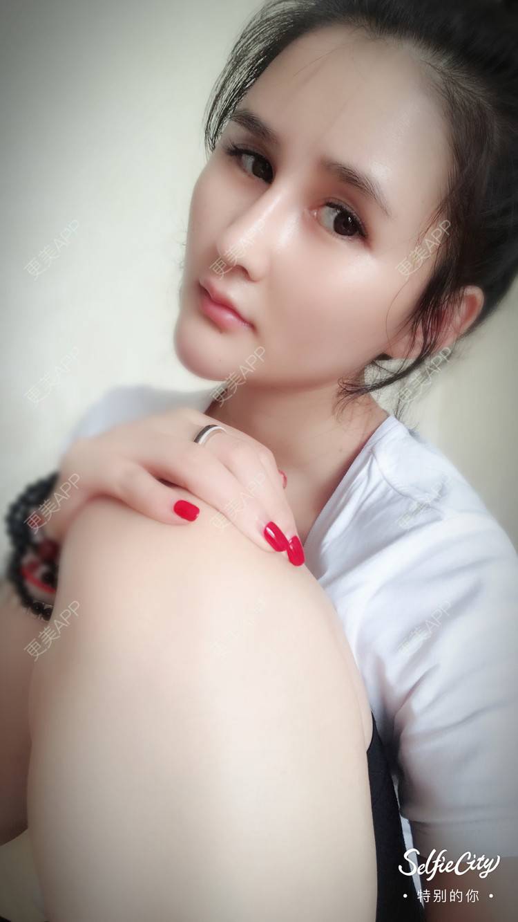 更美 - 空杯空情的自体脂肪垫下巴经验 | 自体脂肪垫下巴 | 成都