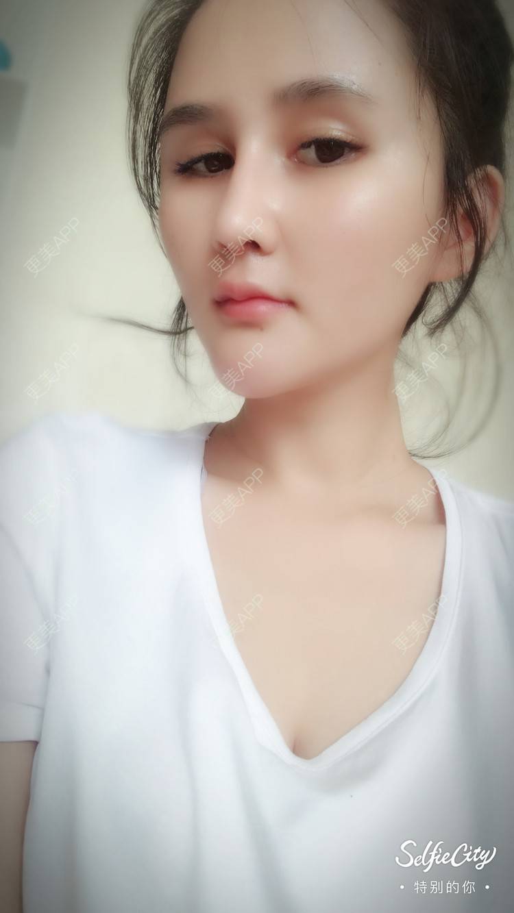 更美 - 空杯空情的自体脂肪垫下巴经验 | 自体脂肪垫下巴 | 成都