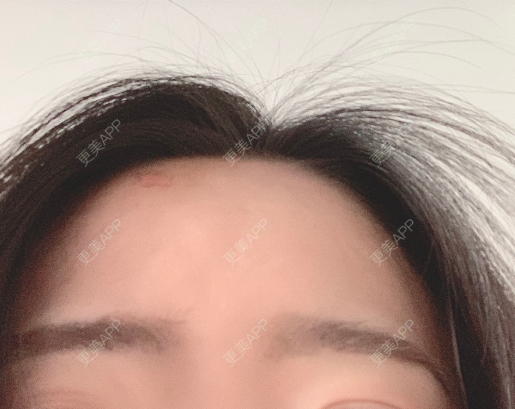 更美 - 更美用户9IGxtujN3L的激光紧缩阴道经验 | 激光紧缩阴道 | 广州