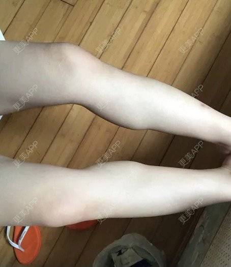 更美 - 更美用户BYgsCmMczy的注射塑形腿部经验 | 注射塑形腿部 | 广州