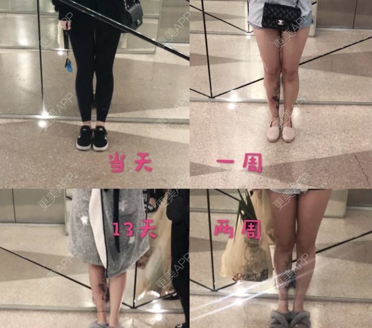 更美 - 更美用户BYgsCmMczy的注射塑形腿部经验 | 注射塑形腿部 | 广州