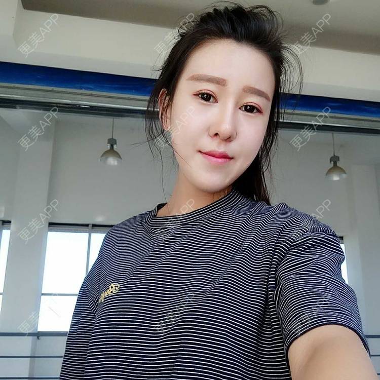 更美 - 更美用户or8Y3L3Y08的自体脂肪全面部填充经验 | 自体脂肪全面部填充 | 自体脂肪丰太阳穴 | 自体脂肪