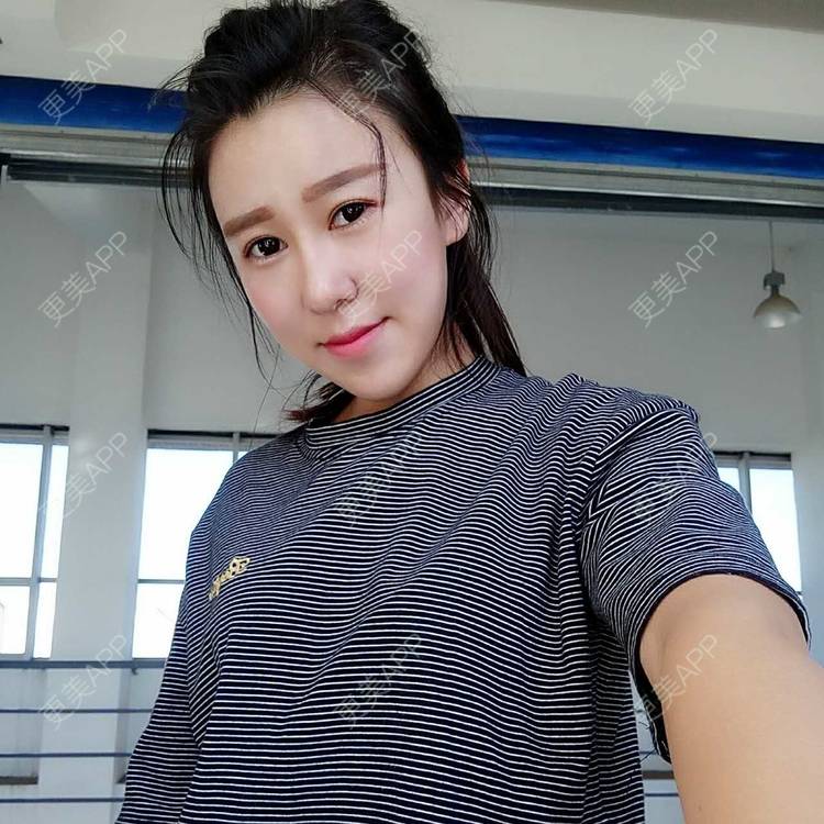 更美 - 更美用户or8Y3L3Y08的自体脂肪全面部填充经验 | 自体脂肪全面部填充 | 自体脂肪丰太阳穴 | 自体脂肪