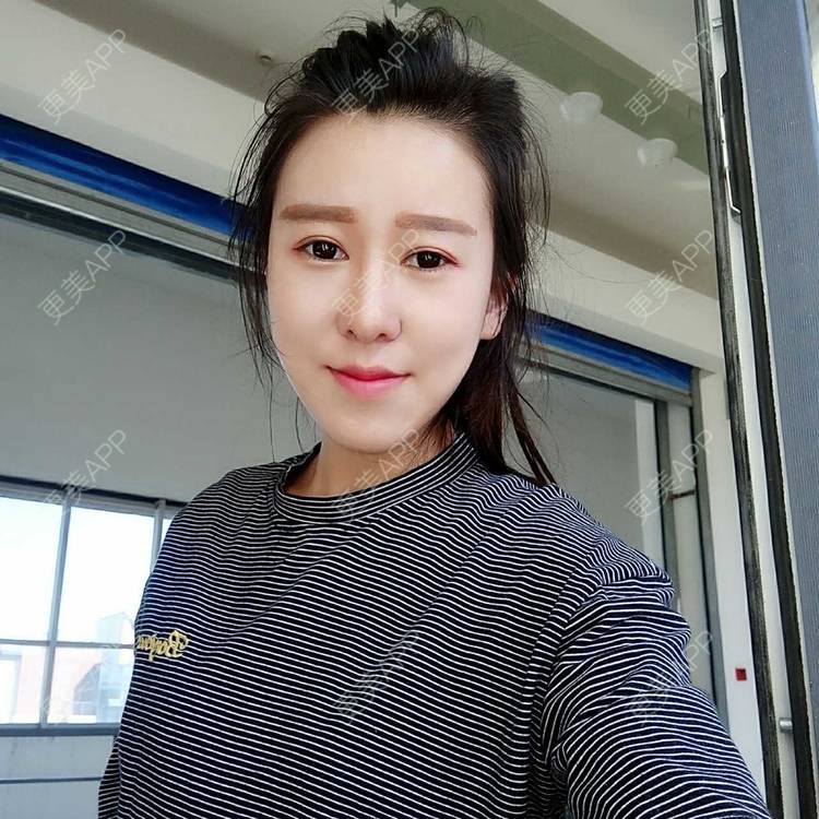 更美 - 更美用户or8Y3L3Y08的自体脂肪全面部填充经验 | 自体脂肪全面部填充 | 自体脂肪丰太阳穴 | 自体脂肪