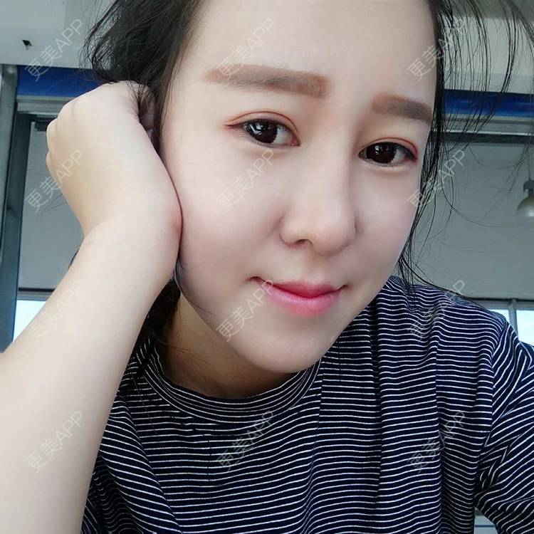更美 - 更美用户or8Y3L3Y08的自体脂肪全面部填充经验 | 自体脂肪全面部填充 | 自体脂肪丰太阳穴 | 自体脂肪