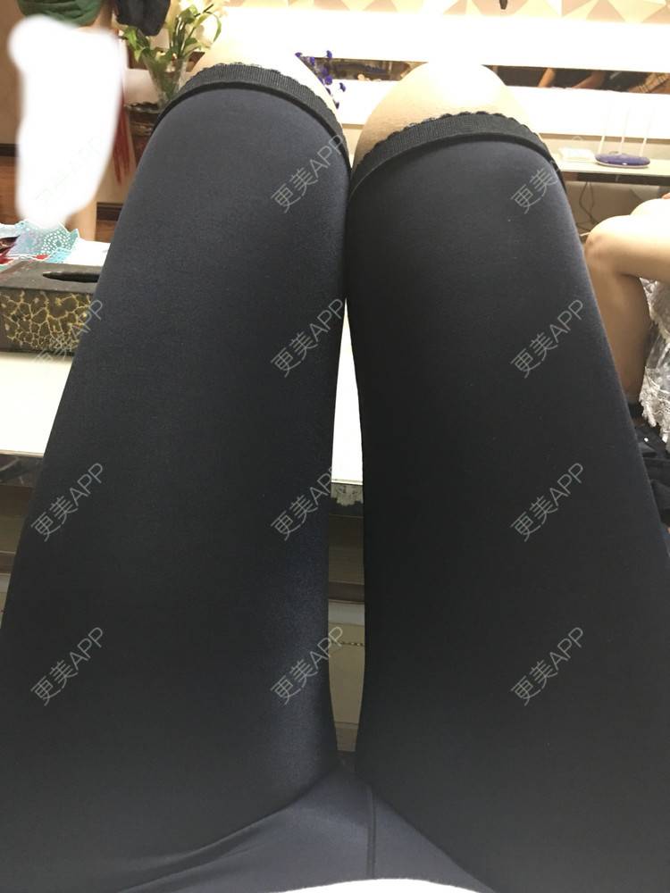 更美 - 彭彭乒乒砰砰的吸脂瘦大腿经验 | 腰部吸脂 | 腹部吸脂 | 吸脂瘦大腿