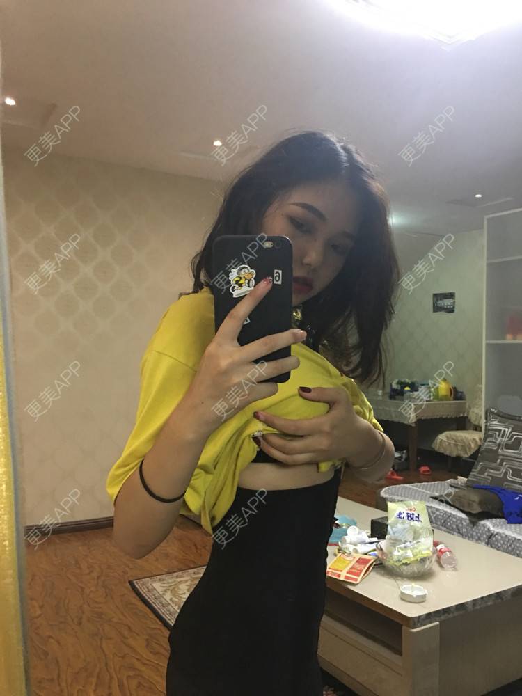 更美 - 彭彭乒乒砰砰的吸脂瘦大腿经验 | 腰部吸脂 | 腹部吸脂 | 吸脂瘦大腿