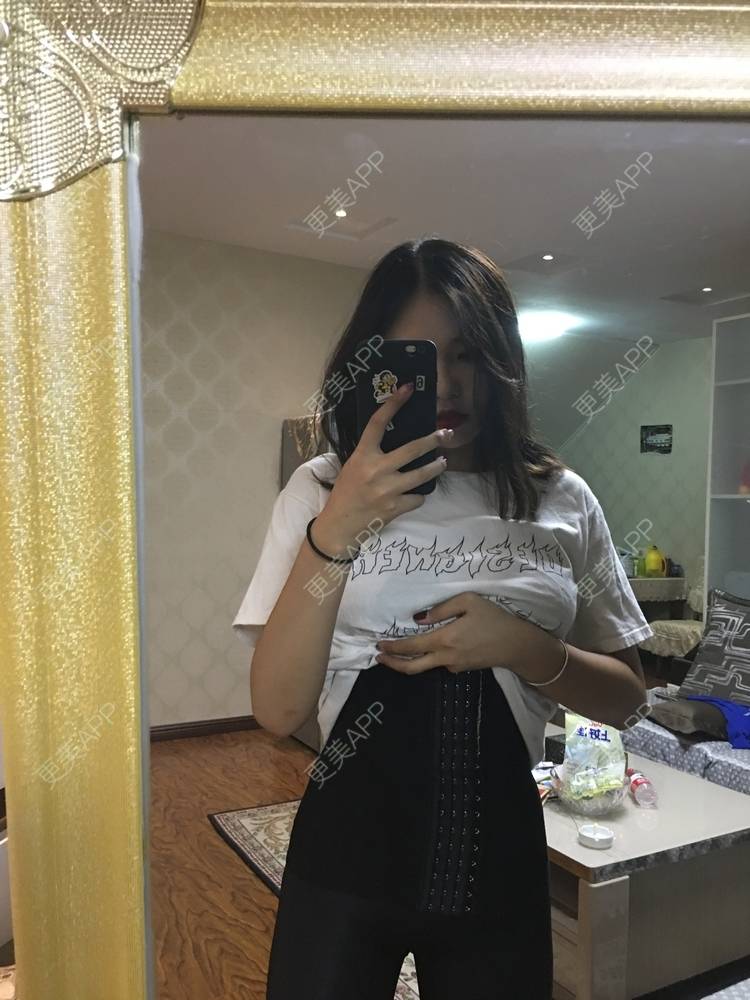 更美 - 彭彭乒乒砰砰的吸脂瘦大腿经验 | 腰部吸脂 | 腹部吸脂 | 吸脂瘦大腿