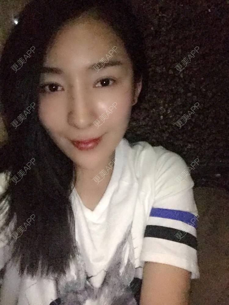 更美 - 愤怒的少年的埋线提升经验 | 成都 | 埋线提升