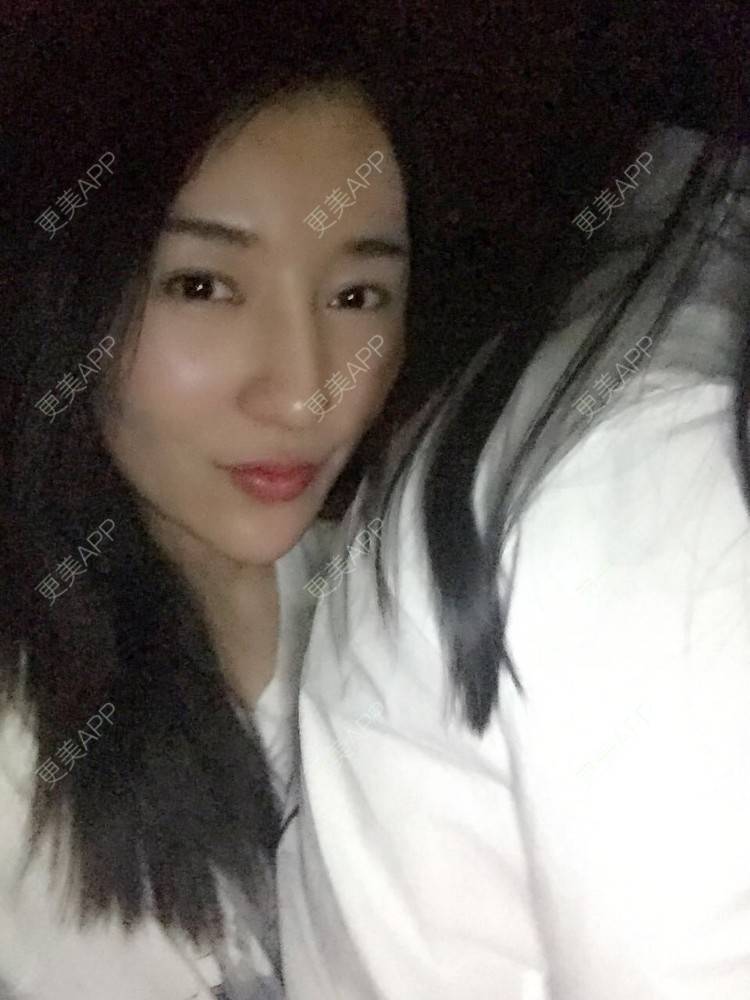 更美 - 愤怒的少年的埋线提升经验 | 成都 | 埋线提升