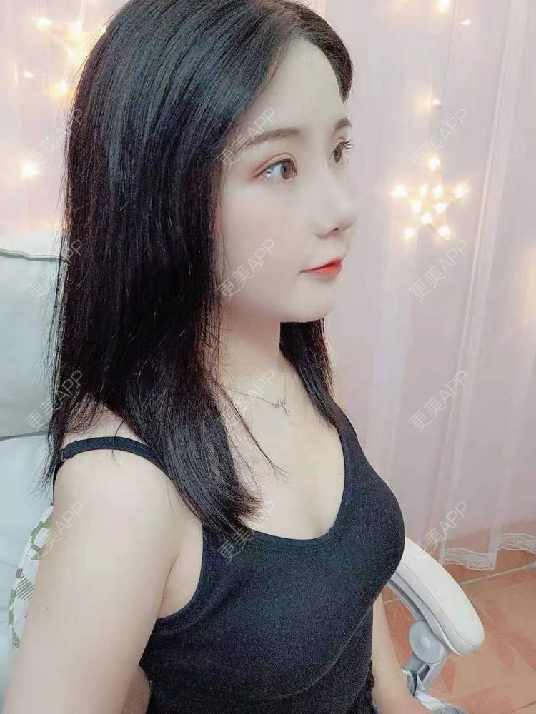 更美 - 尼美们一起的鼻部多项经验 | 鼻部多项 | 膨体隆鼻 | 硅胶隆鼻 | 肋软骨隆鼻 | 耳软骨隆鼻