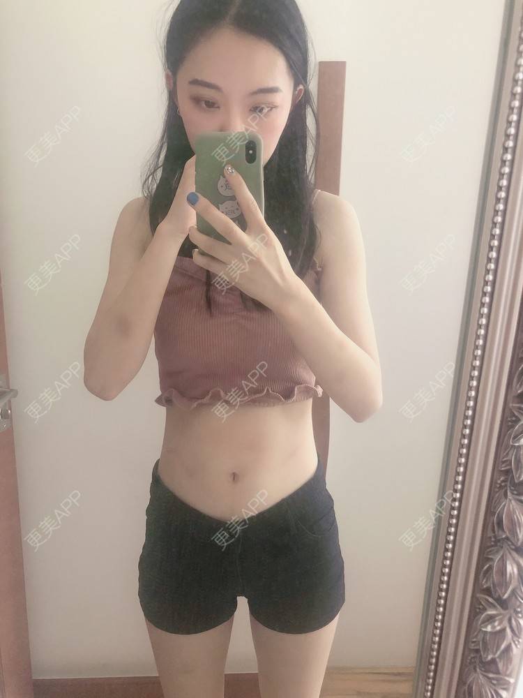 更美 - 小歪诶的腰部吸脂经验 | 腰部吸脂 | 腹部吸脂 | 重庆