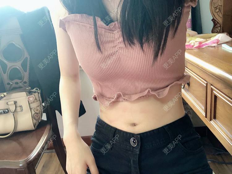 更美 - 小歪诶的腰部吸脂经验 | 腰部吸脂 | 腹部吸脂 | 重庆