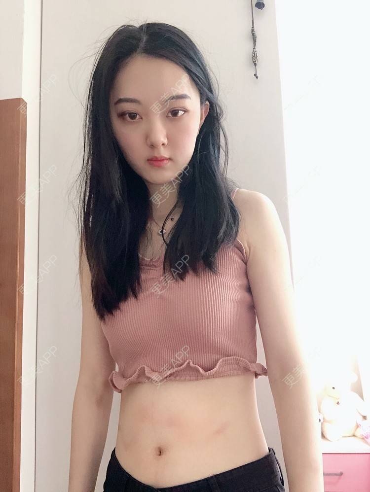 更美 - 小歪诶的腰部吸脂经验 | 腰部吸脂 | 腹部吸脂 | 重庆