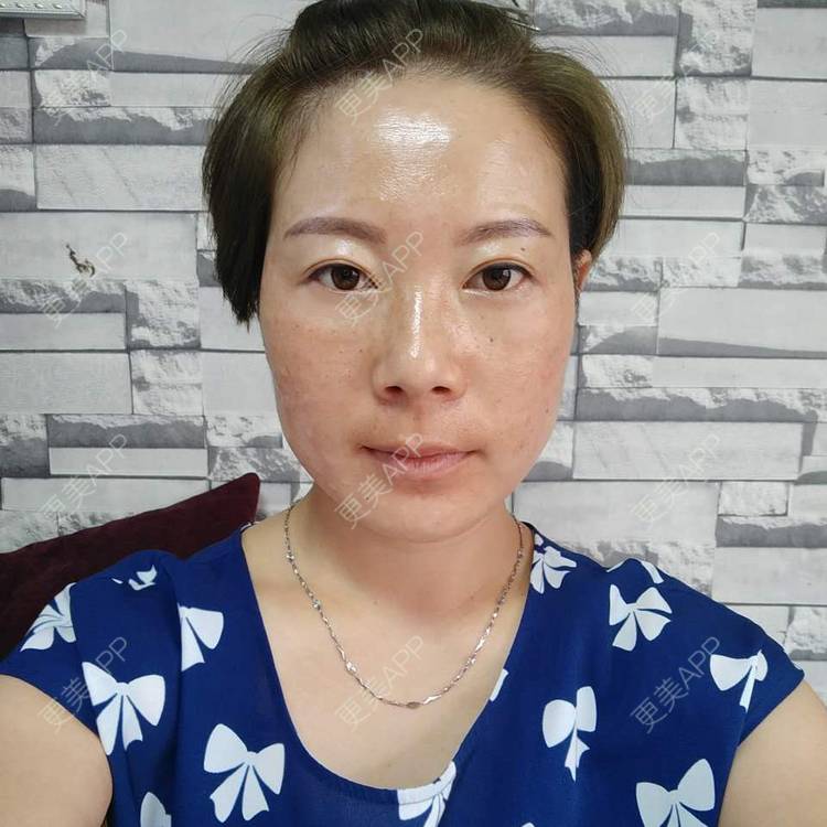 更美 - 不变的唯十二的外切去眼袋经验 | 外切去眼袋 | 成都