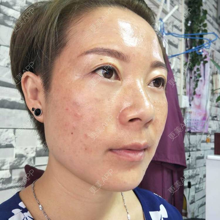 更美 - 不变的唯十二的外切去眼袋经验 | 外切去眼袋 | 成都
