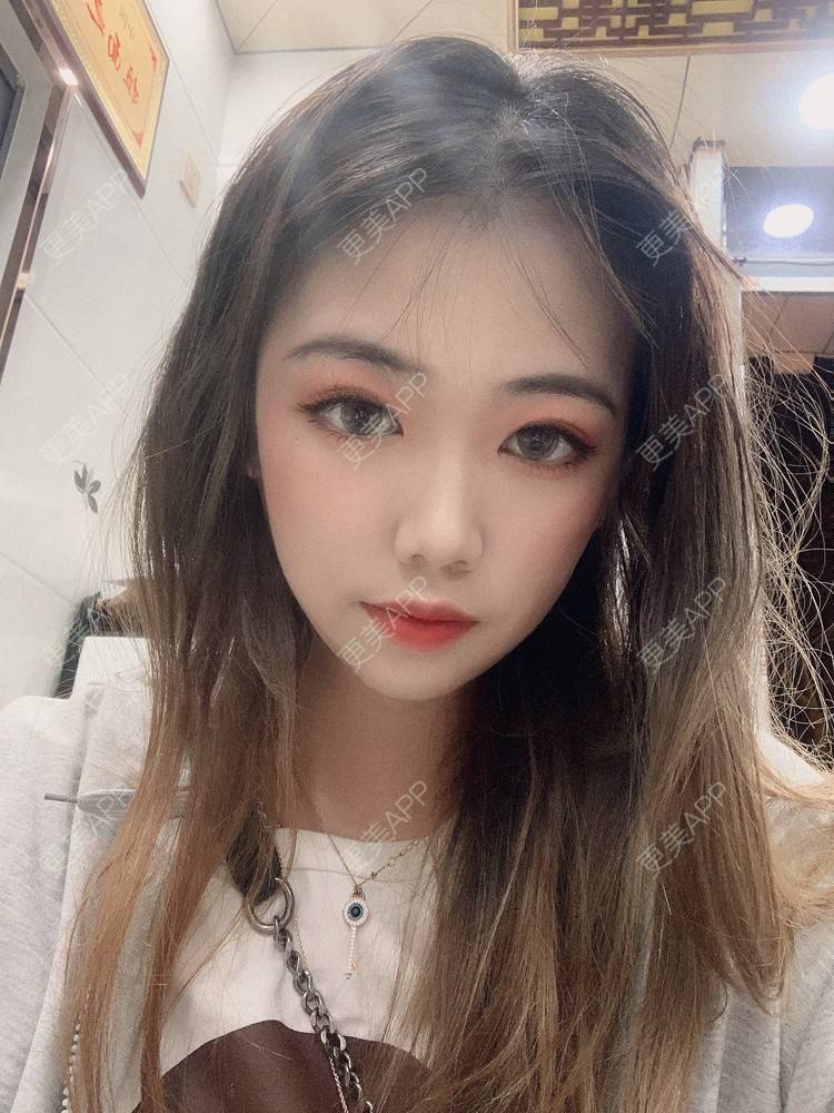 更美 - 淑女注意你的仪态的自体脂肪全面部填充经验 | 杭州 | 自体脂肪全面部填充